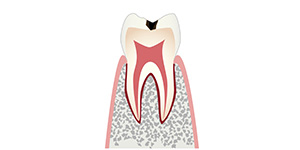 C1「歯に穴があき、虫歯の初期段階です」