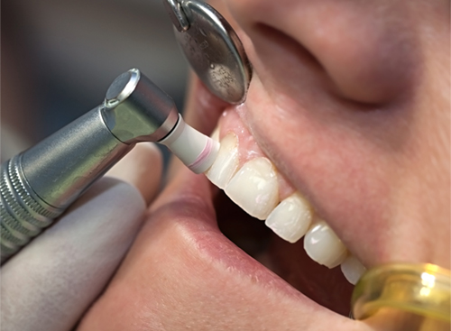 「毎日の歯磨きで取り除けなかった汚れを除去、口内環境を良好にし歯の健康を維持します」