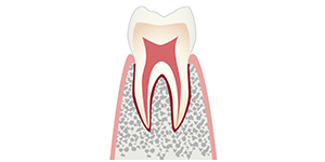 CO「歯が白濁し、虫歯になる前兆段階です」