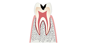 C2「さらに虫歯が進行し、歯が溶かされ続けます」