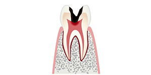 C3「虫歯がさらに深部まで進行し、歯の神経に及びます」