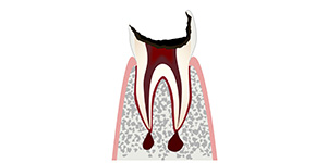 C4「歯が大きく欠損し、抜歯の処置が必要です」