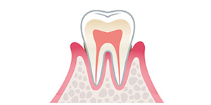 「軽度歯周病」