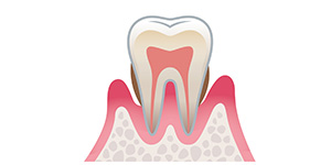 「中度歯周病」