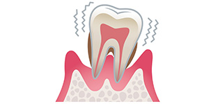 「重度歯周病」